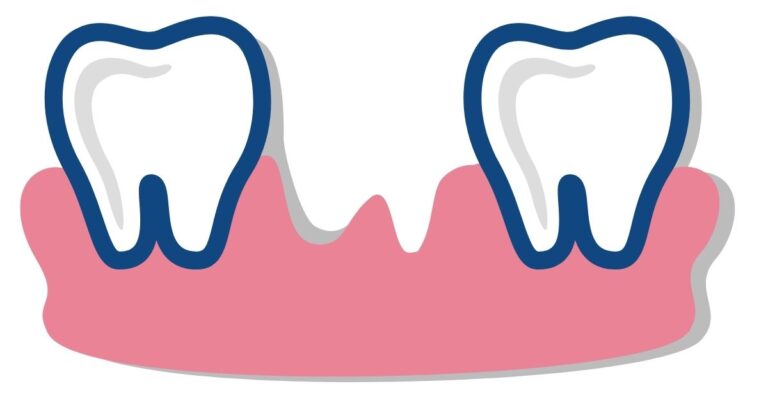 What Happens If You Have a Tooth Pulled and Don’t Replace It?